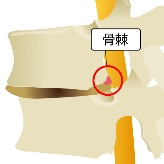 骨棘