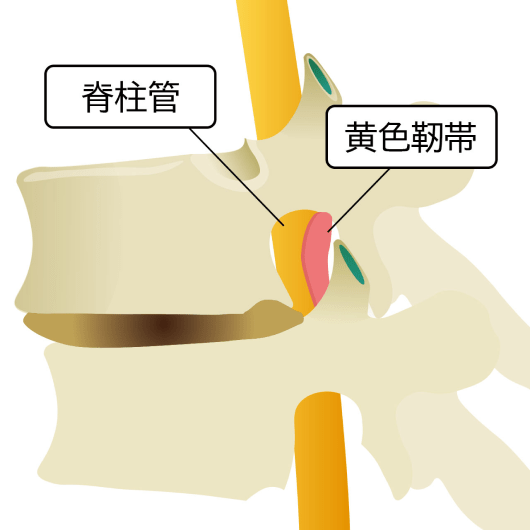 脊柱管 黄色靭帯