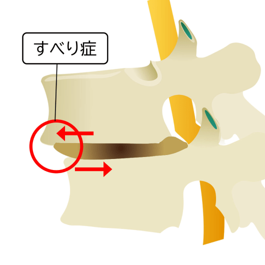 すべり症