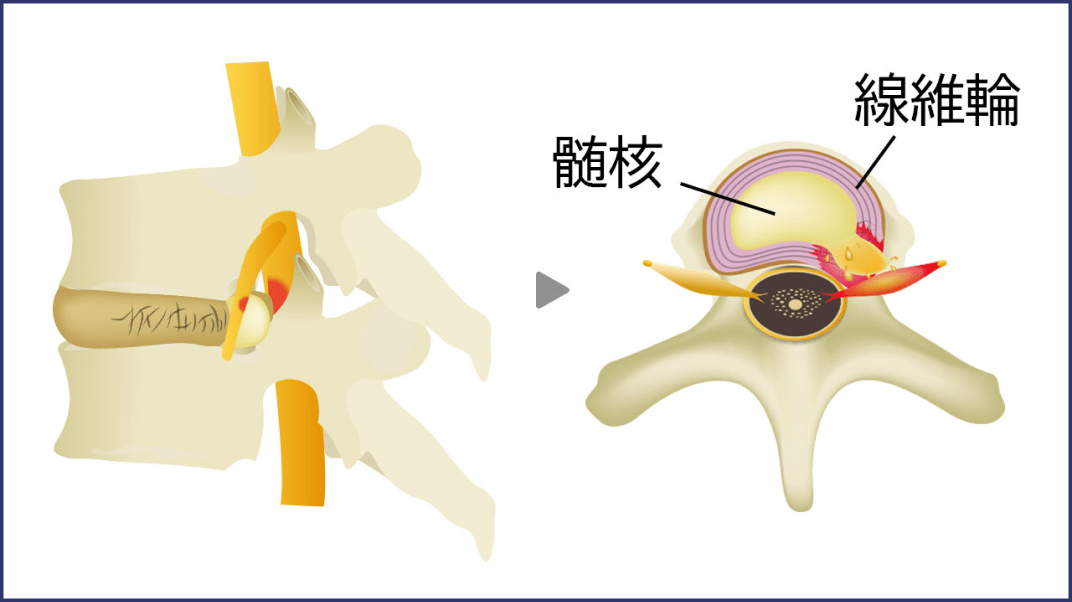 髄核 繊維輪