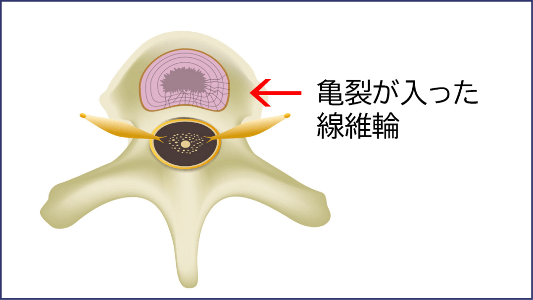 亀裂の入った繊維輪