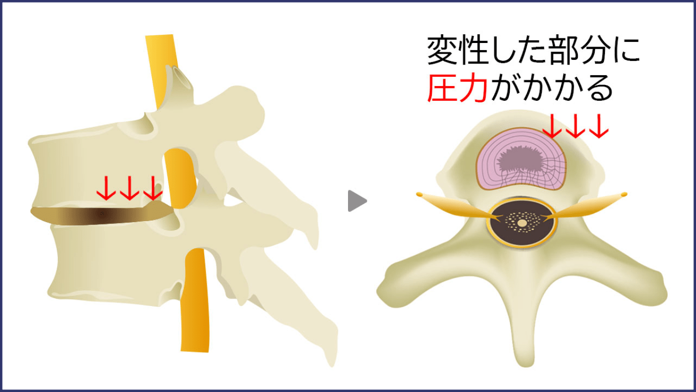 亀裂が入った繊維輪
