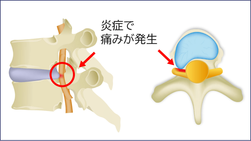 炎症で痛みが発生
