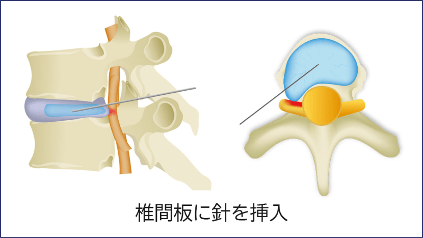 椎間板に針を挿入