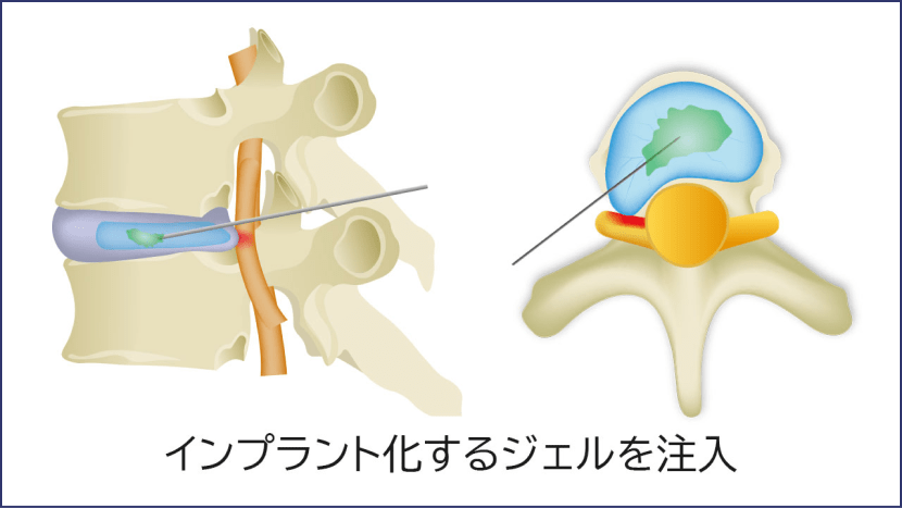 インプラント化するジェルを注入