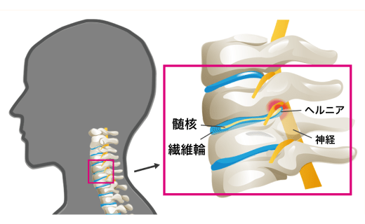 頸椎椎間板ヘルニアのイラスト