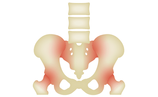 仙腸関節性腰痛のイラスト
