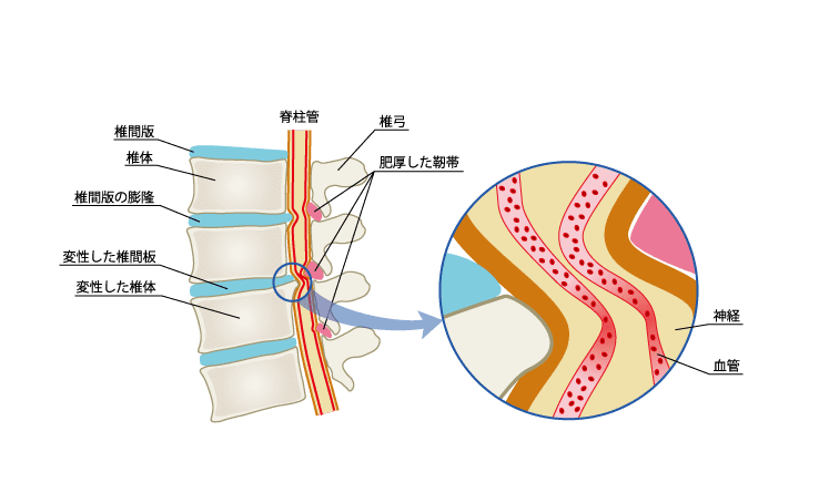 脊柱管狭窄症のイラスト