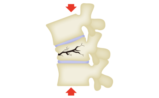 腰椎圧迫骨折のイラスト