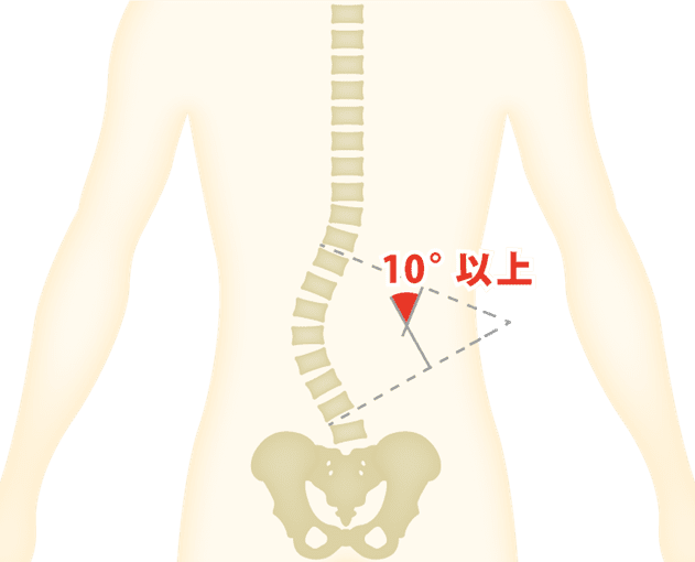 腰椎変性側弯症のイメージ