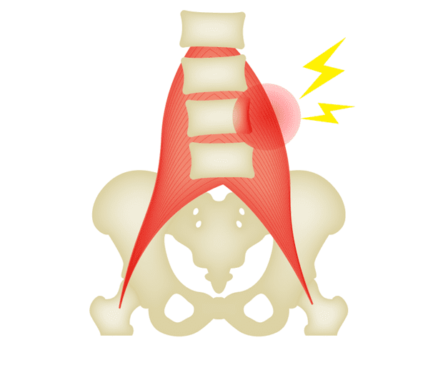 筋・筋膜性腰痛のイメージ