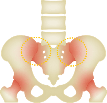 仙腸関節障害のイメージ