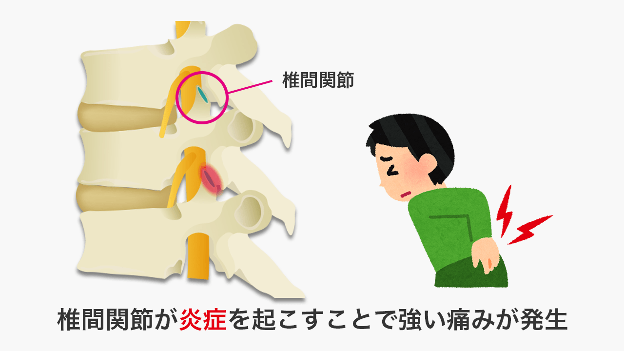 椎間関節が炎症を起こすことで強い痛みが発生