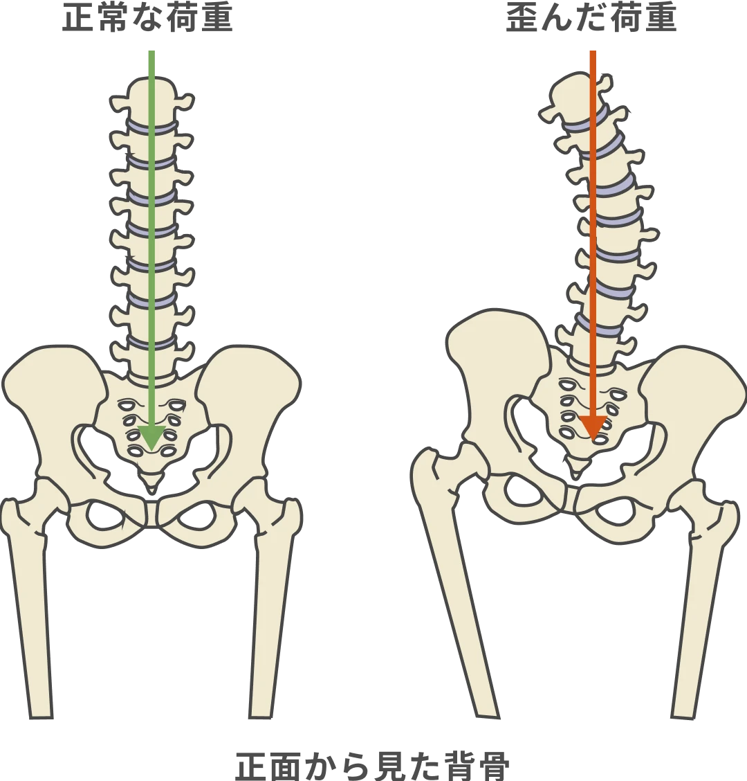 正面から見た背骨、正常な荷重と歪んだ荷重