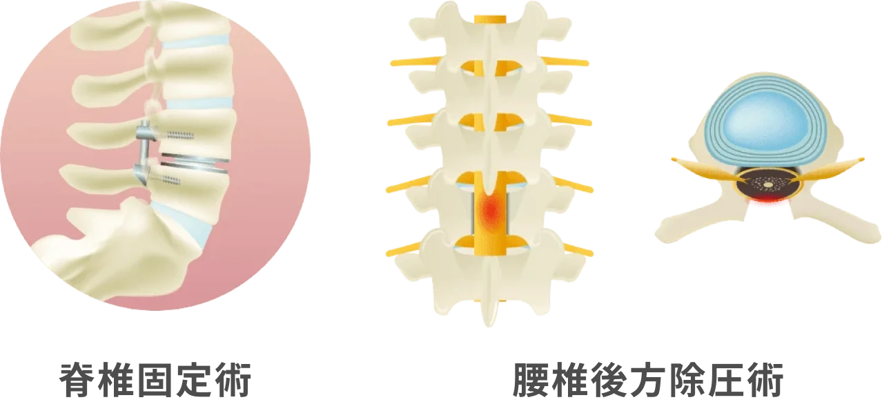 脊椎固定術と腰椎後方除圧術