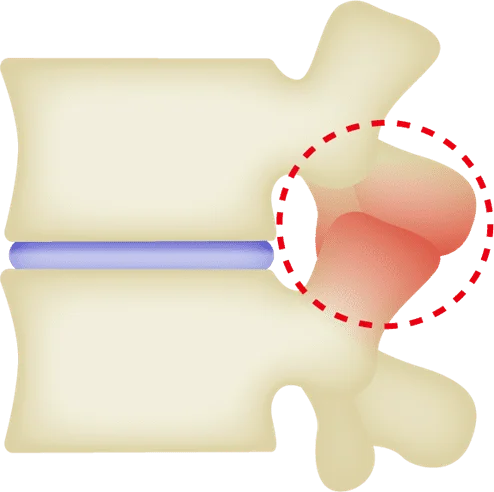 椎間関節の炎症による痛みの図