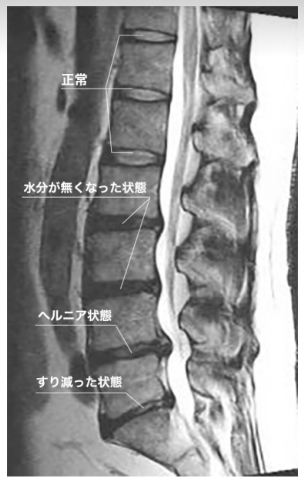椎間板変性と椎間板ヘルニアの写真