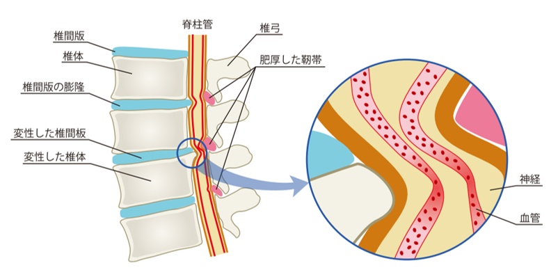 脊柱管狭窄症の原因の図