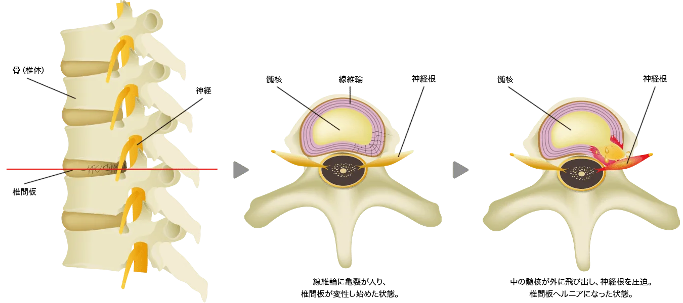 腰部椎間板ヘルニアの再発・再手術について。正しい理解と適切な治療を