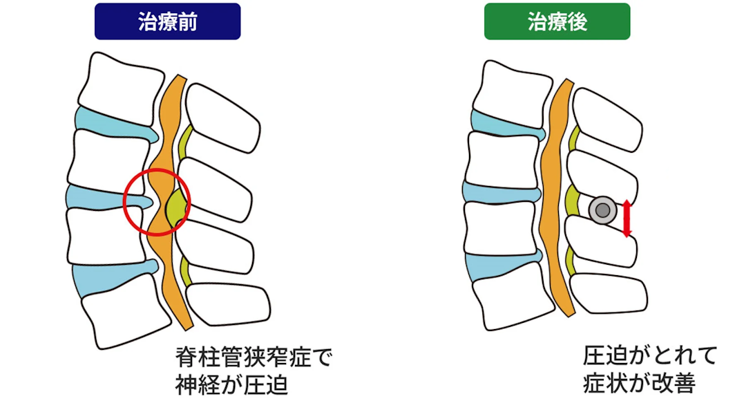 【現役外科医師監修】脊椎固定術とは。どんな方に向く術法なの?具体的に何をやるの?そんな疑問を解消します! | ILC国際腰痛クリニック【公式サイト】