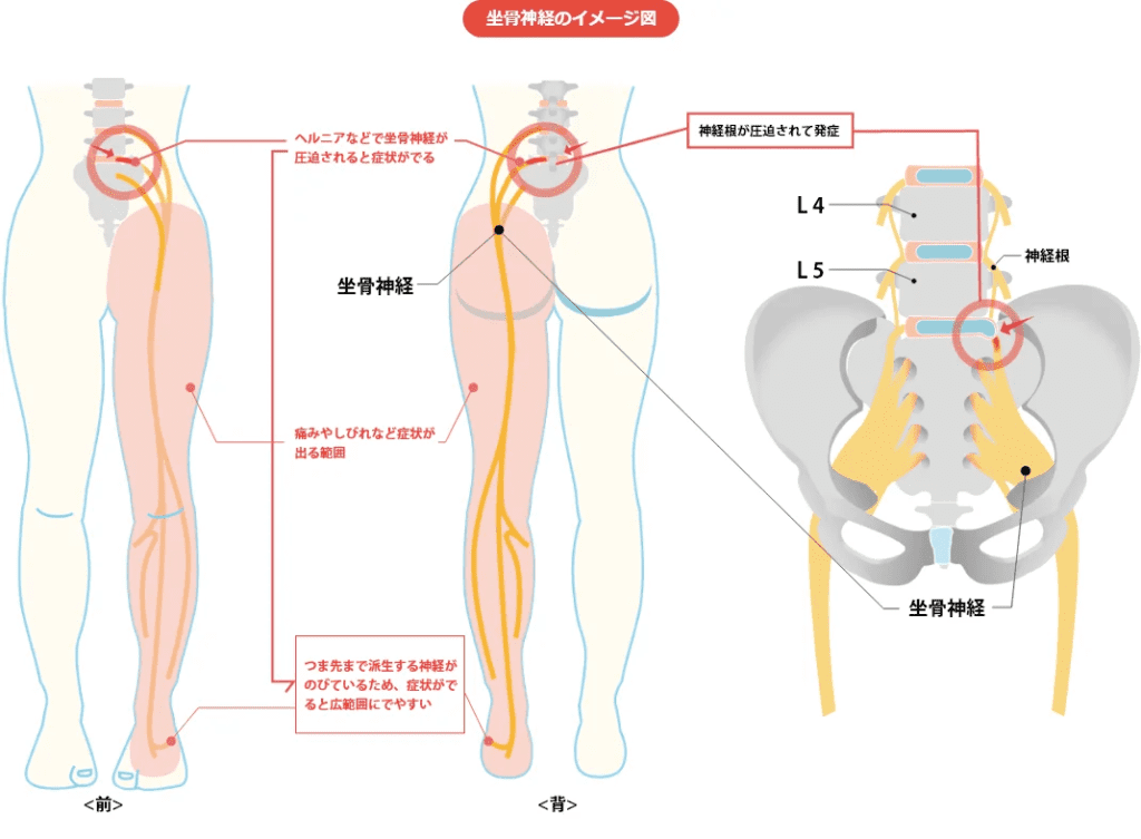 現役外科医師監修】坐骨神経痛とは。原因や症状、治療法を解説 | ILC 