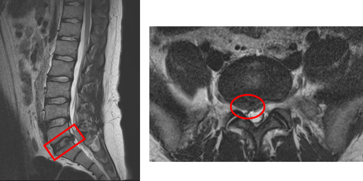 【治療経過のご紹介 No.133】20代椎間板ヘルニアと診断された患者様 ILC国際腰痛クリニック【公式サイト】