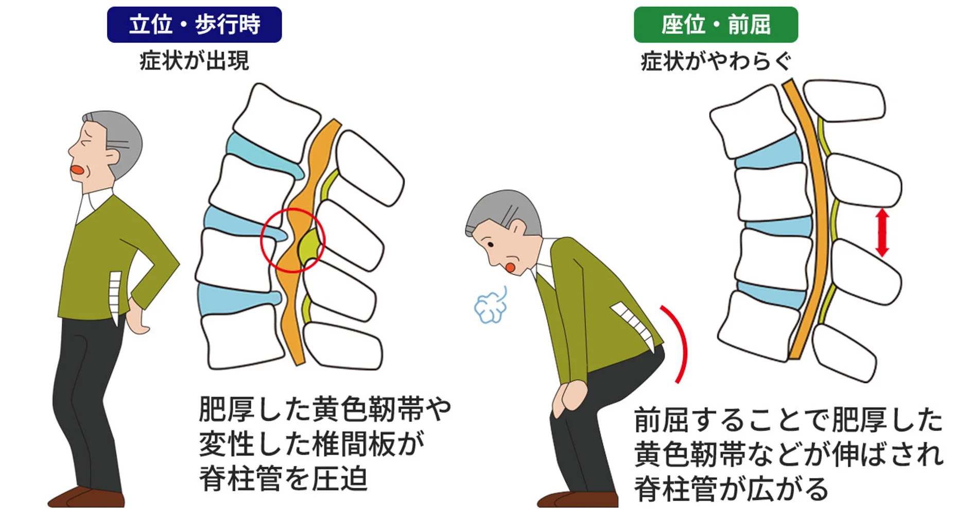 腰椎狭窄症 症状 | 腰椎狭窄症の治し方 : 腰椎狭窄症 症状 について掘り下げる – JSDY